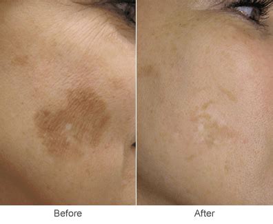 Sun Spot Removal: Pigmented Lesion Skincare Treatments | Midwest Vein Care