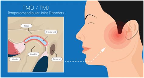 TMJ Treatment Houston | TMJ Disorders Houston TX | TMJ Specialist in ...