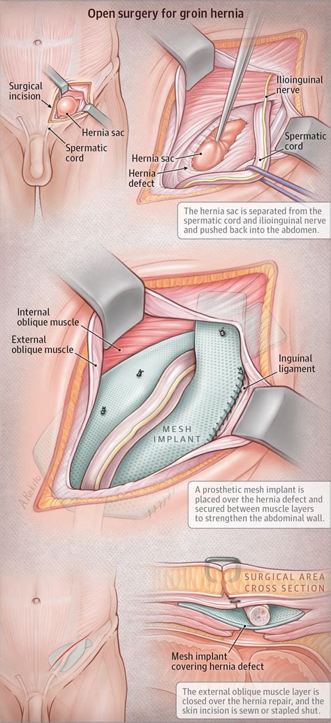 Gambar Operasi Hernia - Homecare24