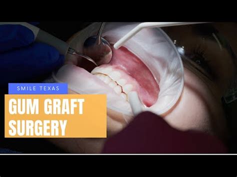 Gum Graft Surgery | Gum Graft Healing Process | Gum Graft Procedure - YouTube