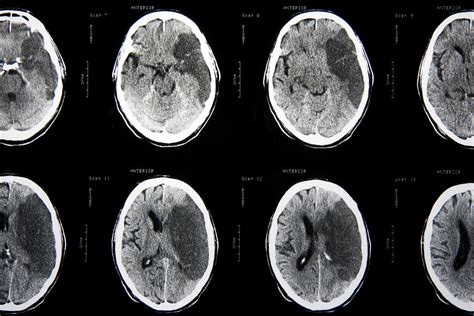 Limiting brain damage in stroke patients by controlling inflammation ...