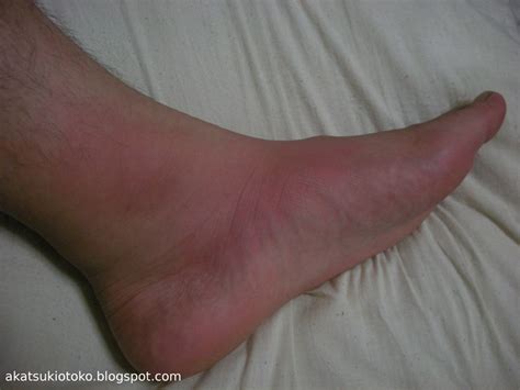 Gout on ankle | Flickr - Photo Sharing!