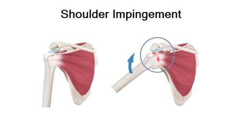 Managing Shoulder Pain After Stroke: 4 Common Causes and Treatments