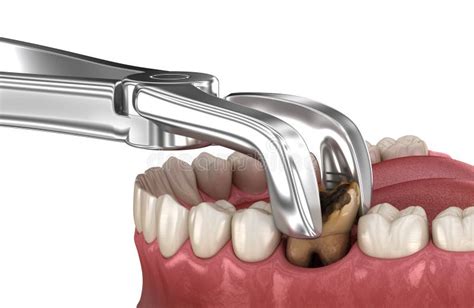 Extraction of Molar Tooth Damaged by Caries. Medically Accurate Tooth ...