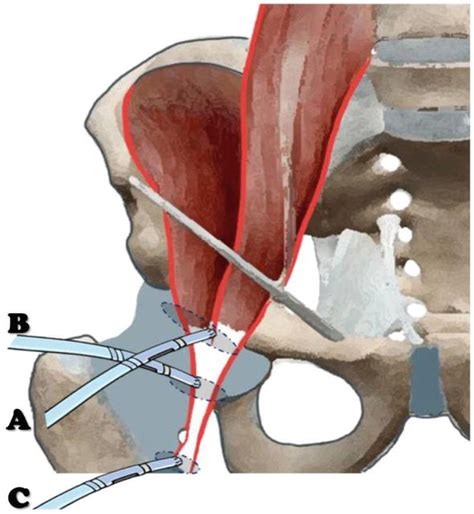 Arthroscopic and Endoscopic Management of the Internal Snapping Hip Syndrome | IntechOpen