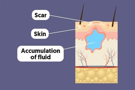 Clear Fluid Drainage From Surgery Site - Best Drain Photos Primagem.Org