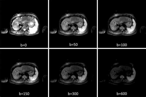 Typical liver IVIM DWI images with six different b-values of ...