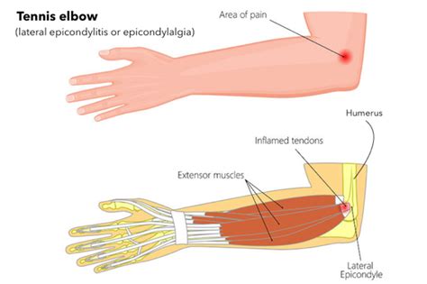 Best Treatment for Elbow pain: Tennis elbow Creekside Chiropractic