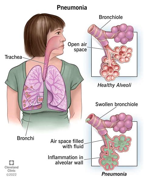 Pneumonia: Causes, Symptoms, Diagnosis & Treatment (2023)