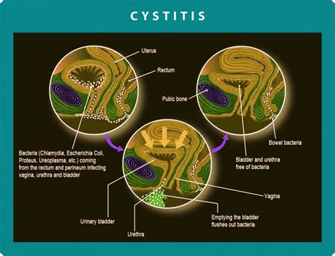 Chronic Cystitis - Diagnosis and Symtoms | Georgiadis Urology