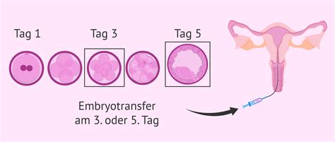 Embryotransfer: Auswahl des besten Zeitpunktes für eine IVF