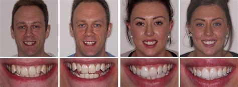 Can You Remove Bonding From Teeth - TeethWalls