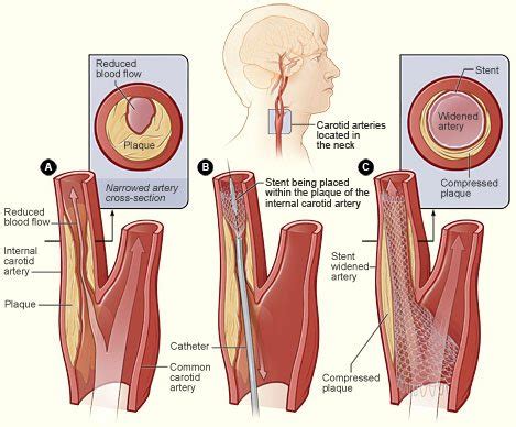 Carotid Artery Stenosis: Surgery, Stent, or Nonsurgical Stroke ...