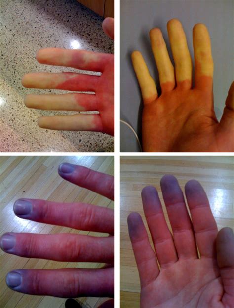 File:Raynaud's Syndrome.jpg - Wikipedia, the free encyclopedia