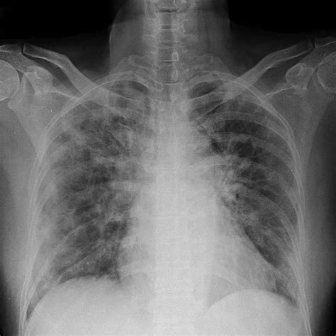 Pneumonia Healthy Lungs Xray - Goimages Urban