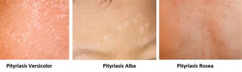 Pityriasis alba: witte vlekjes op de huid