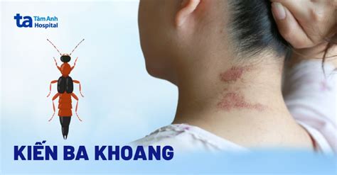 Bị kiến ba khoang cắn nguyên nhân do đâu? Dấu hiệu nhận biết