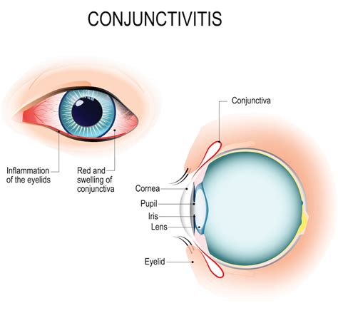 Conjunctivitis - La Pine Eyecare Clinic