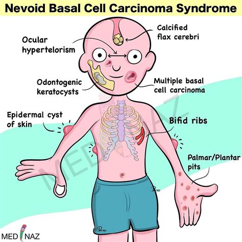 Medinaz Academy - Nevoid Basal Cell Carcinoma Syndrome