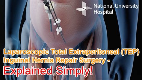 Laparoscopic Total Extraperitoneal (TEP) Inguinal Hernia Repair Surgery - Explained - YouTube