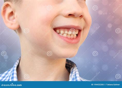 Boy, Kid Smiling with Open Mouth, Close Up of Childâ€™s Mouth, Teeth, Concept of Child Skin Care ...