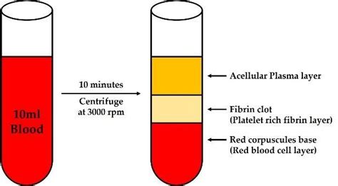 The method of preparation of platelet rich fibrin. A blood sample is... | Download Scientific ...