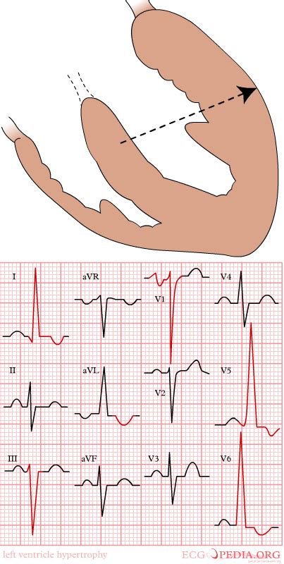 Aortic stenosis electrocardiogram - wikidoc