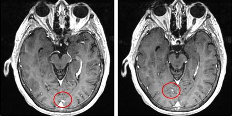 Leptomeningeal carcinomatosis causes, symptoms, prognosis & treatment