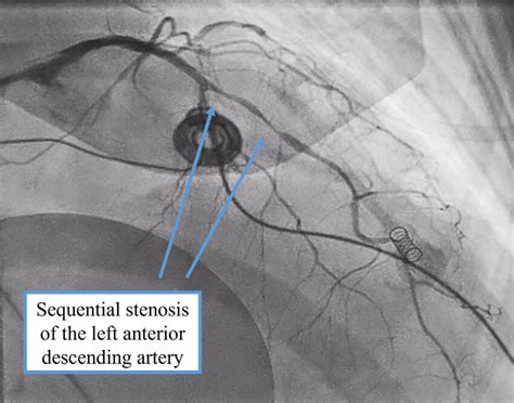 Coronary Angiogram Showing Coronary Vasospasm | Download Scientific Diagram