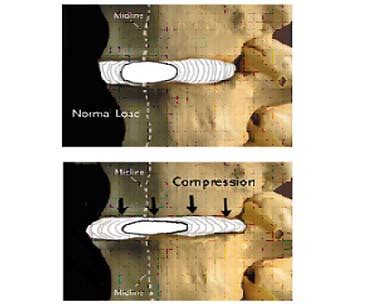 India Disc Degeneration Surgery DDD, Disease,Degenerative Disc Surgery