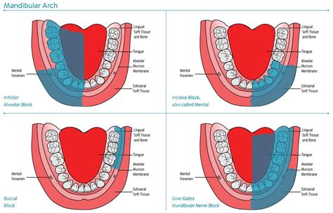 Mandibular Injection Sites | Dental hygiene school, Dental hygiene student, Dental fun