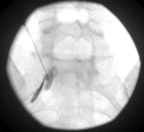 Lumbar Transforaminal Epidural Steroid Injection - WikiMSK