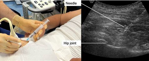 Platelet-rich-plasma (PRP) injections in the hip