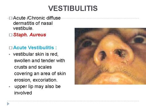 DISEASES OF THE EXTERNAL NOSE NASAL VESTIBULE FOREIGN