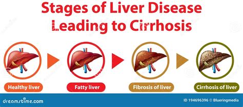 Stages Liver Damage Set Dd Ww Isol Cartoon Vector | CartoonDealer.com #220661637