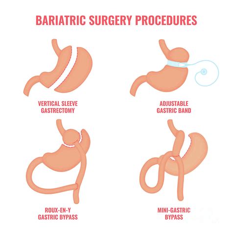 Bariatric Surgery Types Photograph by Art4stock/science Photo Library | Pixels