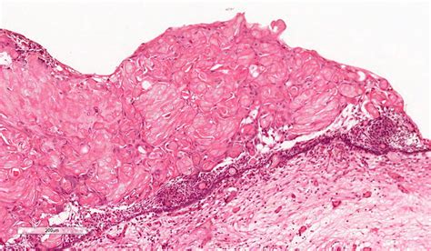 Pathology Outlines - Calcifying odontogenic cyst