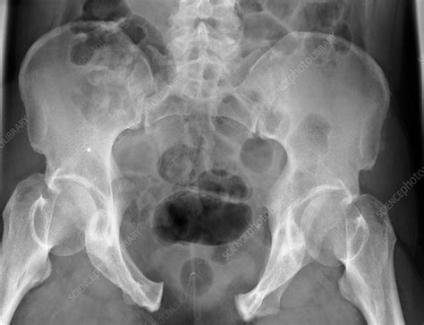 Pelvic fracture, X-ray - Stock Image C010/3405 - Science Photo Library