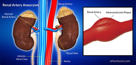 Renal Artery Aneurysm: Treatment, Causes, Types, Symptoms