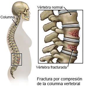 Síntesis de hơn 16 artículos: como dormir con fractura de vértebra ...