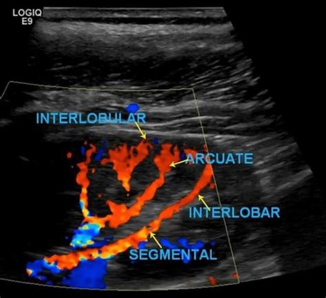 Renal Transplant Duplex Protocol – Sonographic Tendencies