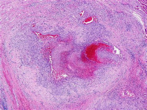 Pathology Outlines - Epithelioid sarcoma