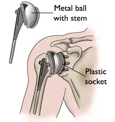 Shoulder Joint Replacement - OrthoInfo - AAOS