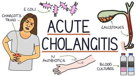 Understanding Acute Cholangitis (Ascending Cholangitis) - YouTube