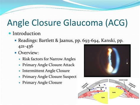 PPT - Diagnosis and Management of Angle Closure Glaucoma PowerPoint ...