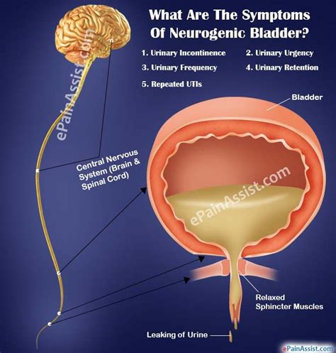 What Are The Symptoms Of Neurogenic Bladder? | Bladder incontinence, Overactive bladder, Chronic ...