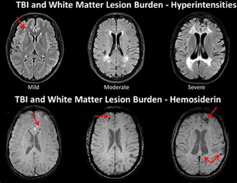 Traumatic Brain Injury Mri