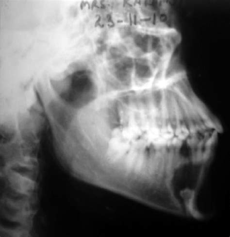 Lateral oblique radiograph showing well-defined unilocular radiolucency... | Download Scientific ...