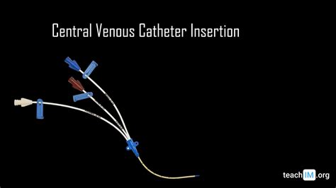 Central Venous Catheter Insertion | Procedures | TeachIM