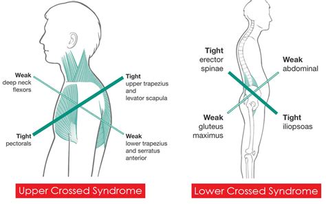 Cross syndrome causes, symptoms, diagnosis, treatment & exercises